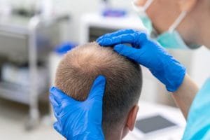 Syarat Transplantasi Rambut: Apa yang Harus Anda Persiapkan?