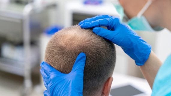 Syarat Transplantasi Rambut: Apa yang Harus Anda Persiapkan?