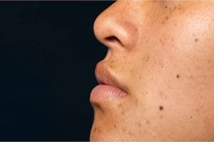 Flek Hitam di Wajah: Beda Melasma, PIH, dan Sun Spot