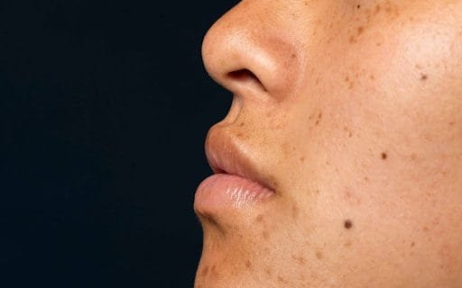 Flek Hitam di Wajah: Beda Melasma, PIH, dan Sun Spot