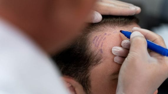 Berapa Lama Proses Tanam Rambut? Ini Informasi Lengkapnya untuk Anda