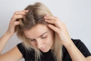 15 Cara Mengatasi Rambut Rontok dan Ketombe agar Kulit Kepala Tetap Sehat