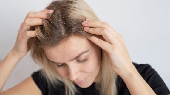 15 Cara Mengatasi Rambut Rontok dan Ketombe agar Kulit Kepala Tetap Sehat