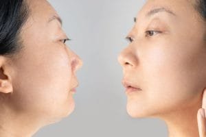 Apakah Double Chin Bisa Hilang? Ini Dia Jawabannya!