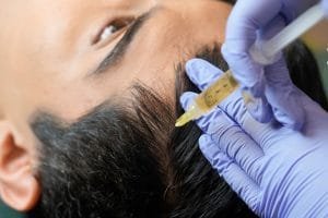 PRP Rambut Harga Mahal? Anda Bisa Cari Tahu Informasinya di Sini!