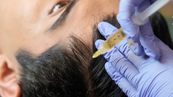 PRP Rambut Harga Mahal? Anda Bisa Cari Tahu Informasinya di Sini!
