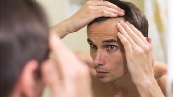 Transplantasi Rambut Gagal? Ini Penyebab dan Pantangan yang Harus Diperhatikan