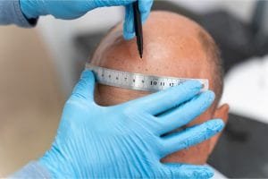klinik scalp micropigmentation