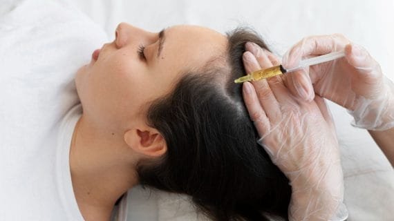 7 Pantangan Setelah PRP Rambut agar Hasil Perawatan Maksimal