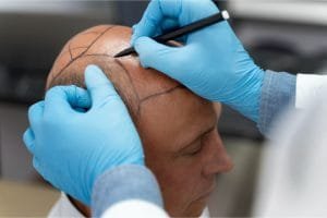Scalp Micropigmentation: Solusi Tampilan Rambut Tebal dan Natural