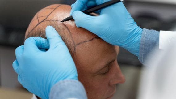 Scalp Micropigmentation: Solusi Tampilan Rambut Tebal dan Natural