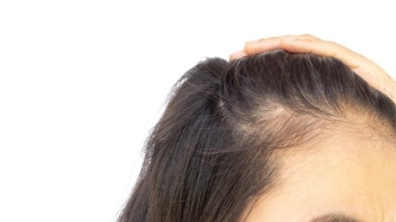 Rambut Pitak Wanita: Penyebab, Cara Mengatasi, dan Solusi Efektif