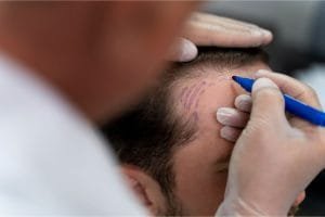 Siapa Saja yang Cocok untuk Tanam Rambut? Ini Penjelasan Lengkapnya