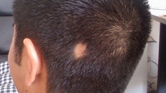 Kenapa Bisa Terjadi Alopecia pada Pria Muda dan Apa yang Bisa Dilakukan