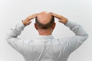 Penyebab Kebotakan dan Solusi Medisnya agar Rambut Tetap Sehat