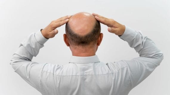 Penyebab Kebotakan dan Solusi Medisnya agar Rambut Tetap Sehat