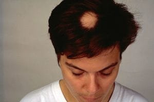Solusi Lengkap Untuk Mengatasi Alopecia Areata agar Rambut Kembali Sehat