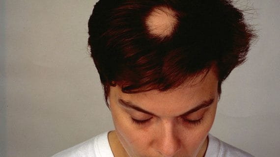 Solusi Lengkap Untuk Mengatasi Alopecia Areata agar Rambut Kembali Sehat