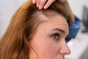 Solusi Rambut Rontok Parah Karena Alopecia, Kenali Penyebab, Ciri, dan Perawatannya!