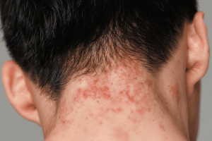 Dermatitis Seboroik dan Cara Tepat Mengatasinya