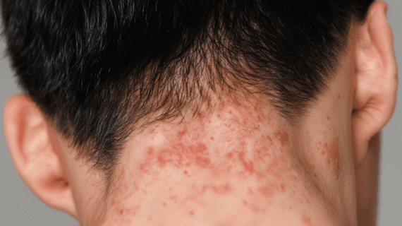 Dermatitis Seboroik dan Cara Tepat Mengatasinya