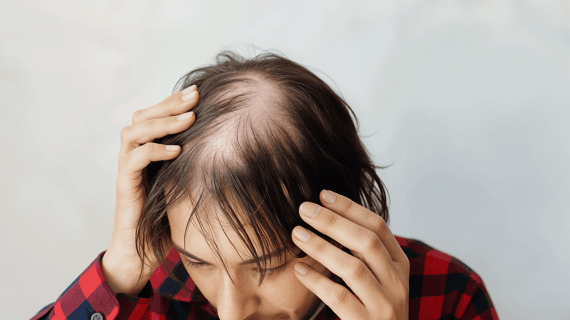Obat Penumbuh Rambut Rekomendasi Ahli: Solusi Penipisan dan Kebotakan