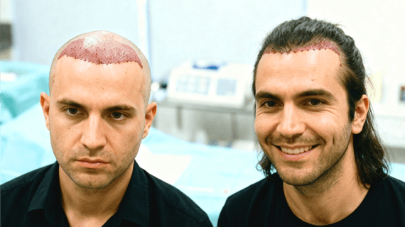 Transplantasi Rambut Tanpa Botak: Solusi Tanam Rambut Tanpa Perubahan Drastis