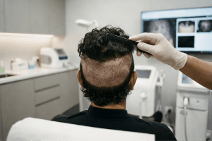 Long Hair FUE: Teknik Transplantasi Rambut dengan Rambut Panjang