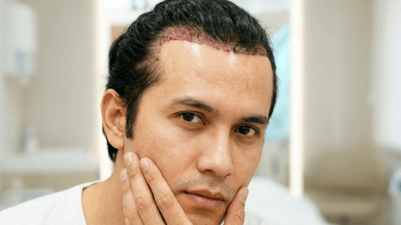 Non Shaven FUE: Solusi Tanam Rambut Minim Perubahan Visual