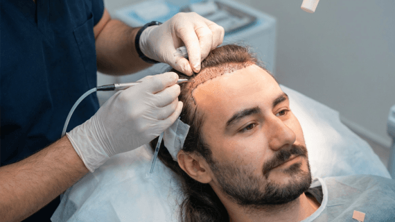 Mengenal Teknik Unshaven Follicular Unit Extraction