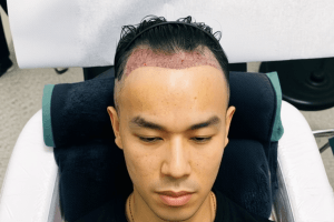 Hair Transplant Tanpa Cukur: Transplantasi Rambut Tanpa Botak