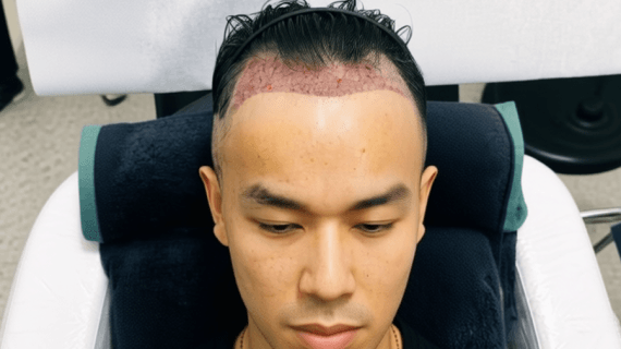 Hair Transplant Tanpa Cukur: Transplantasi Rambut Tanpa Botak