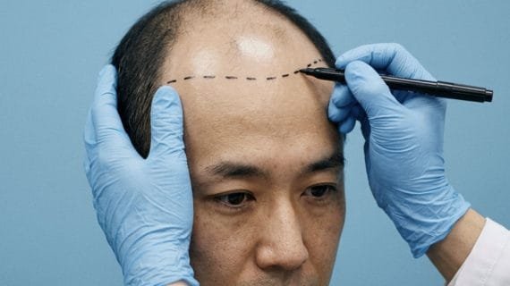 Tanam Rambut: Prosedur, Manfaat, dan Hasil yang Bisa Diharapkan